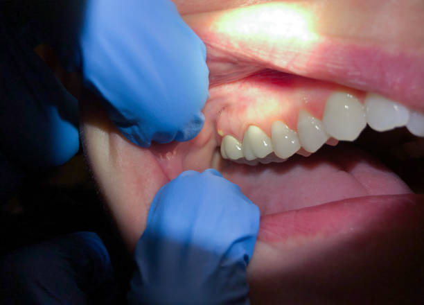 Best Broken or Cracked Tooth Emergency Dentist in Spencerville, MD